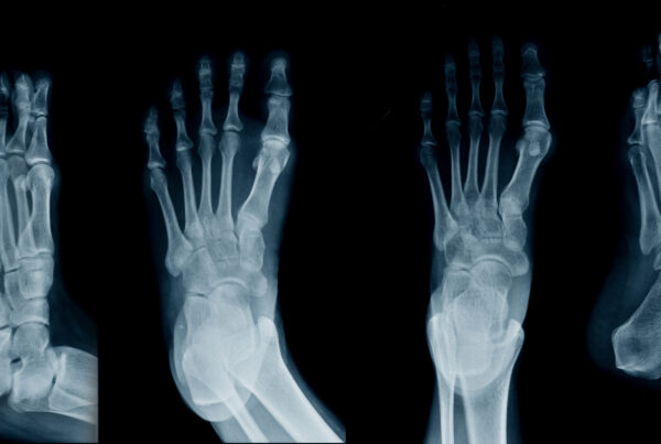 X-ray images are used to look for a stress fracture