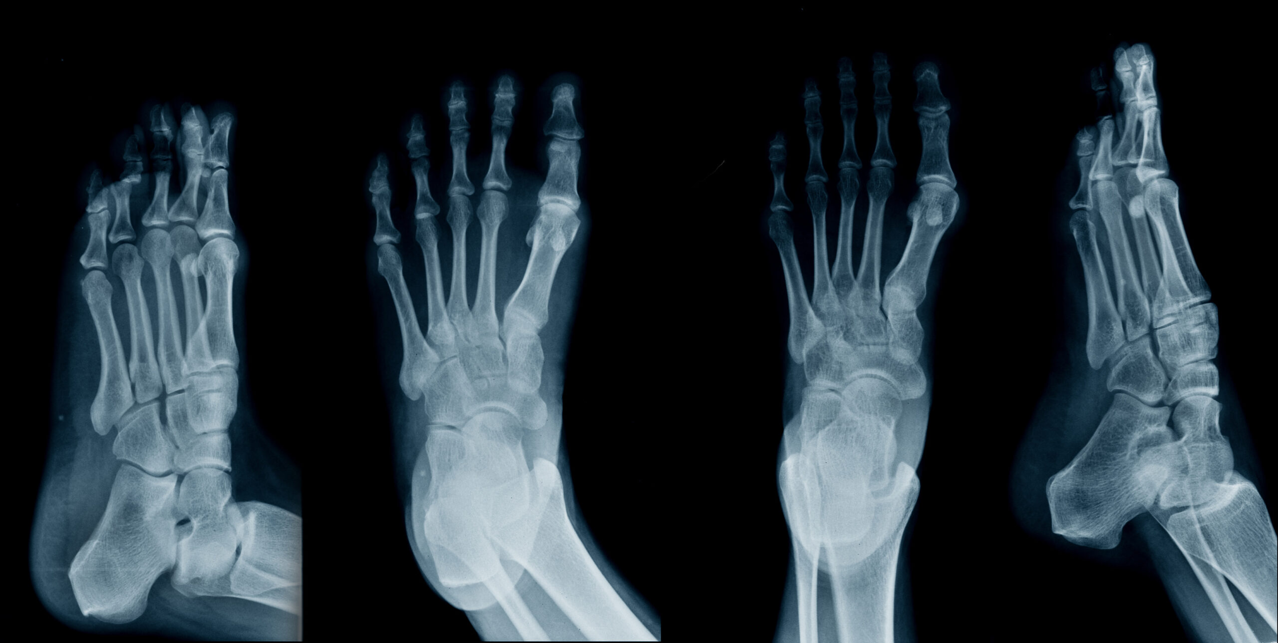 What is a stress fracture?